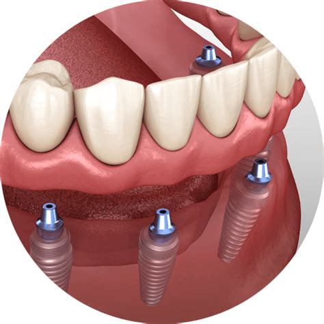 dental implants yuba city|Yuba City Dentistry .